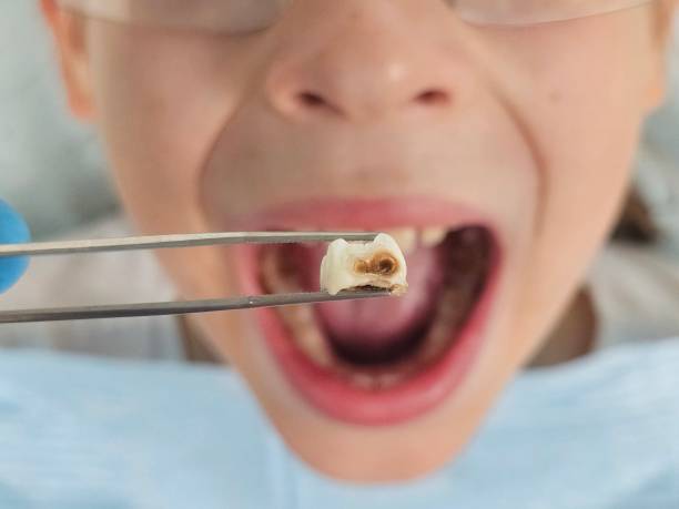 Best Emergency Wisdom Tooth Extraction in Russell, KS